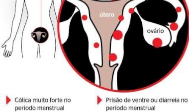 Endometriose: conheça as causas, sintomas e tratamento da doença que afeta 8 milhões de mulheres no Brasil