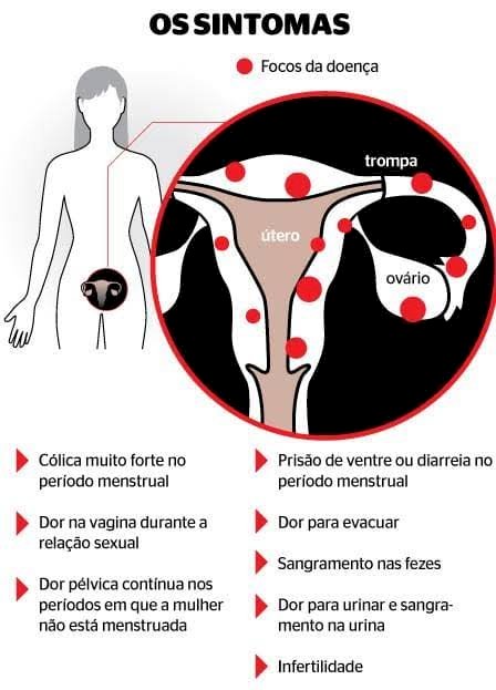 Endometriose: conheça as causas, sintomas e tratamento da doença que afeta 8 milhões de mulheres no Brasil
